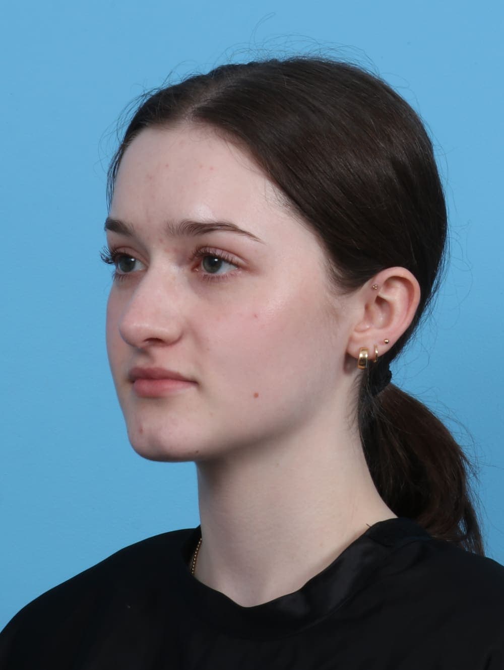 Rhinoplasty case #4481 after, image 3