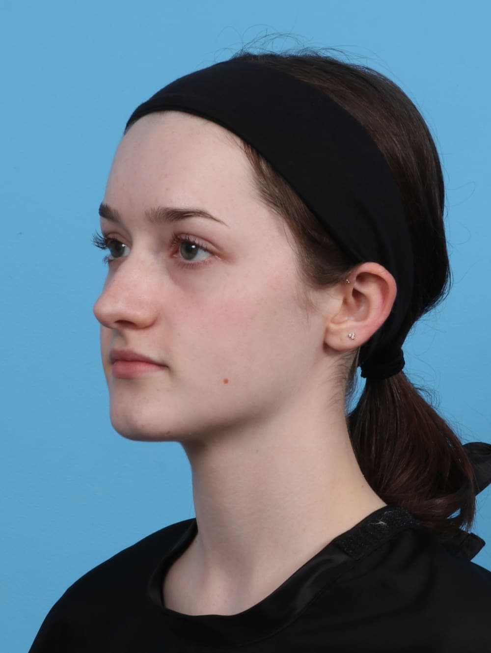 Rhinoplasty case #4481 before, image 3