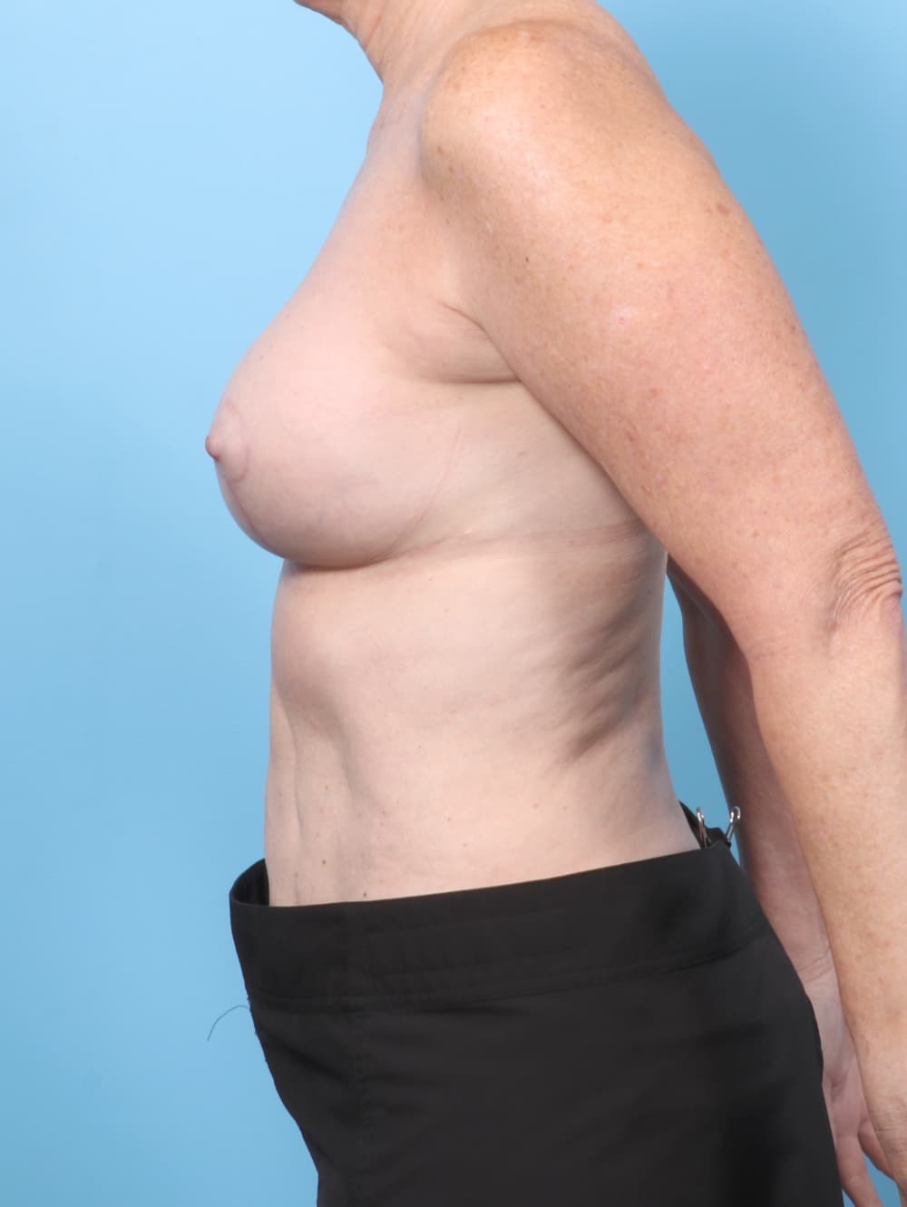 Breast Implant Revision case #8423 after, image 3