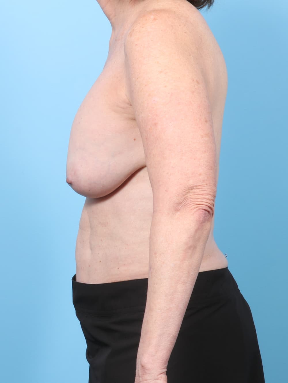 Breast Implant Revision case #8423 before, image 3