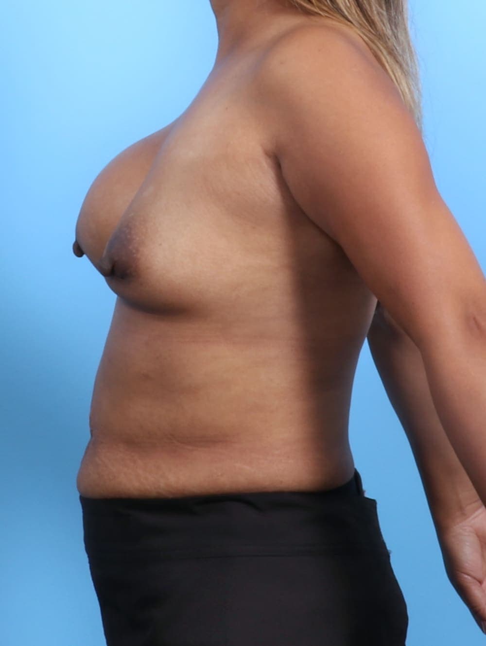 Breast Implant Revision case #3351 before, image 3