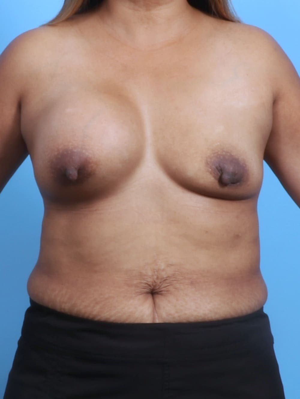 Breast Implant Revision case #3351 before, image 1
