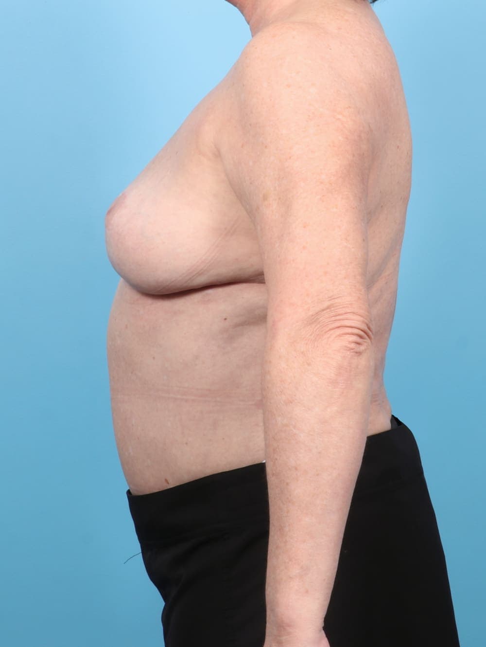 Breast Implant Removal with Lift case #6785 after, image 3