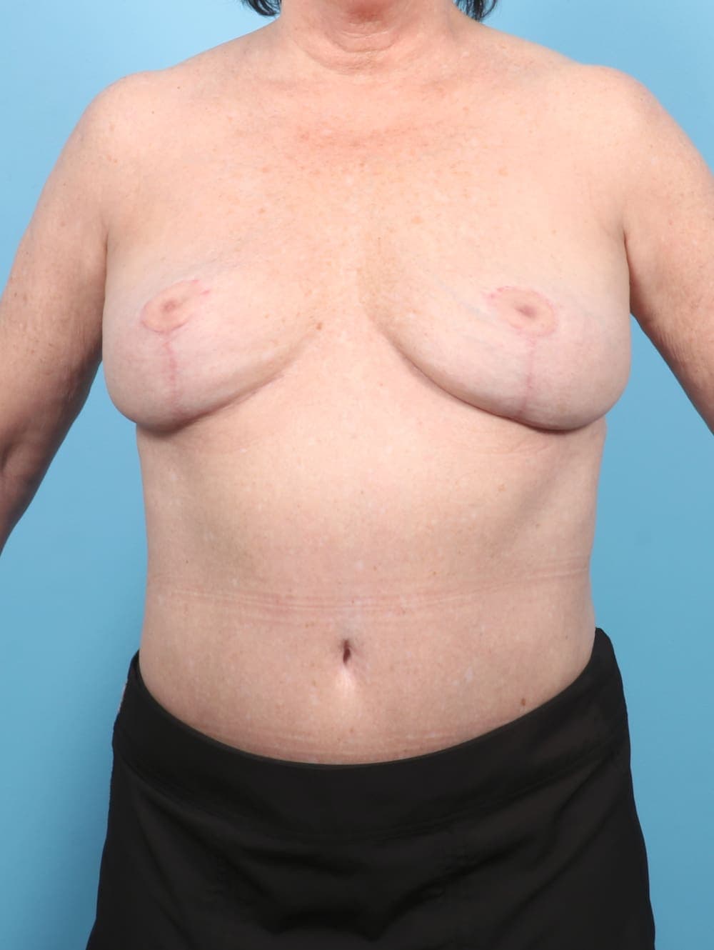 Breast Implant Removal with Lift case #6785 after