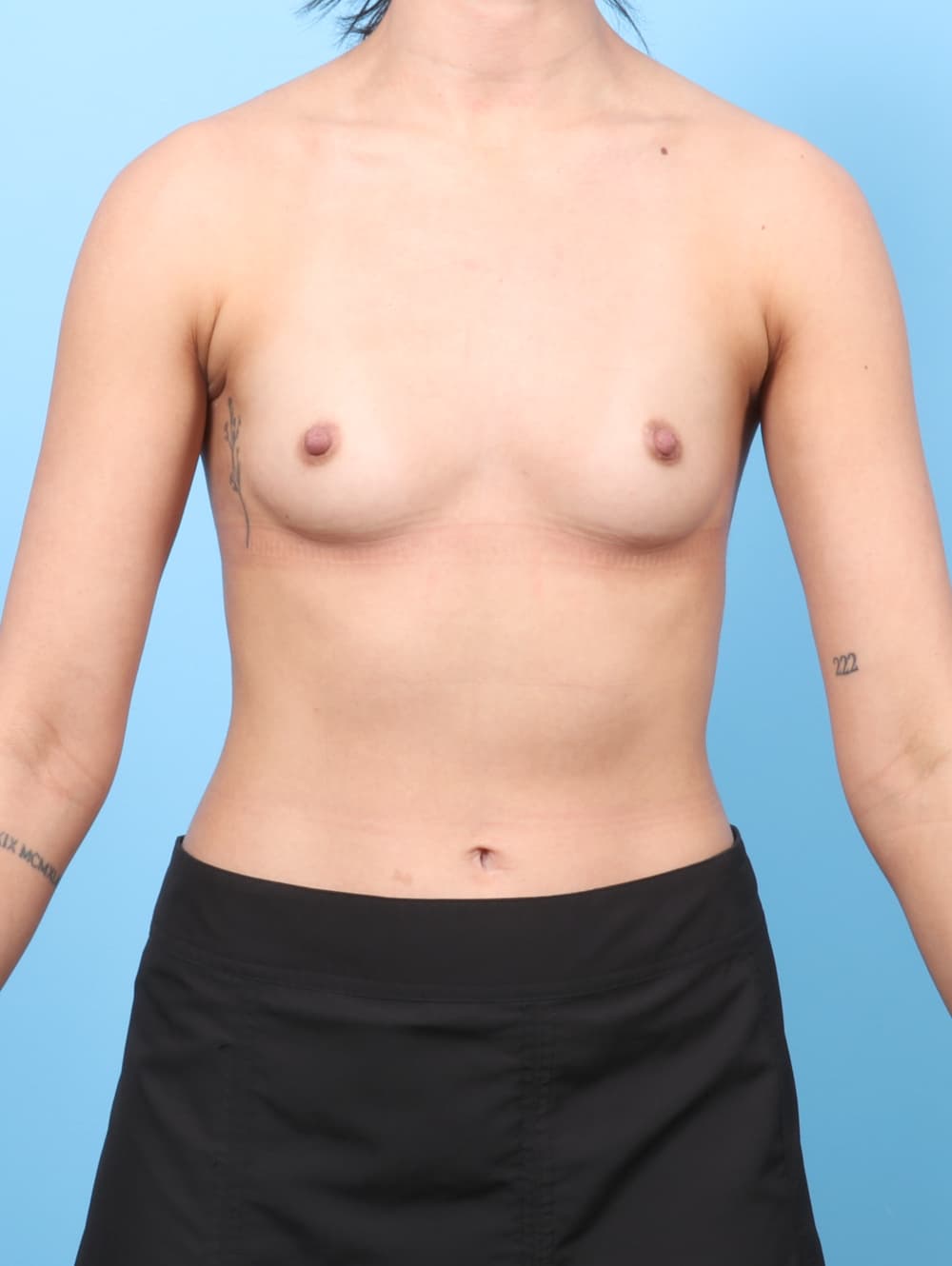 Breast Augmentation case #8447 before, image 1