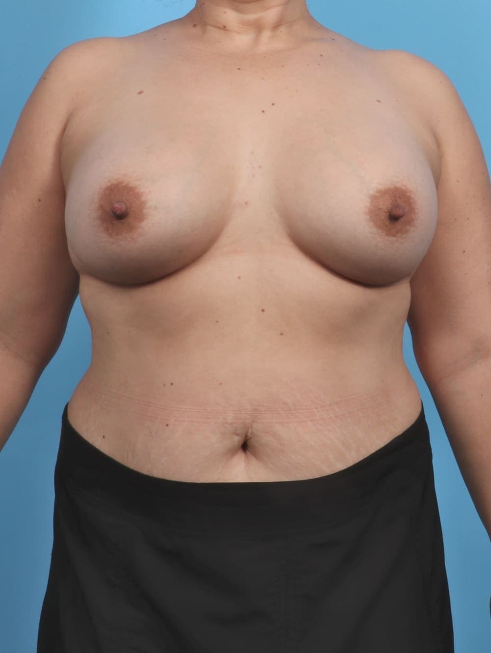 Breast Lift with Implants case #4347 after, image 1