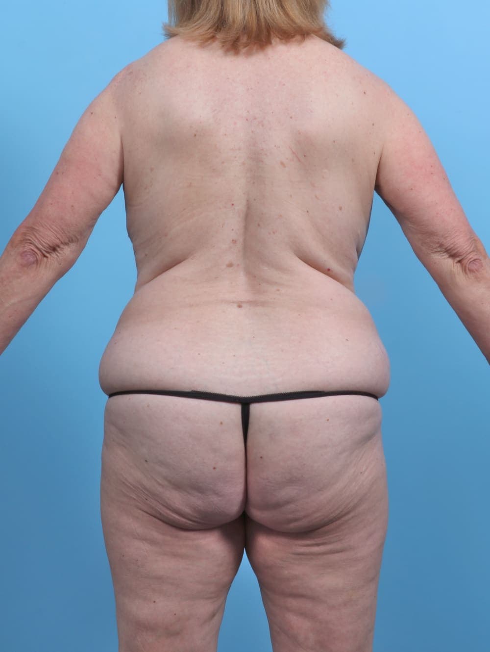 Mommy Makeover case #4972 before, image 4