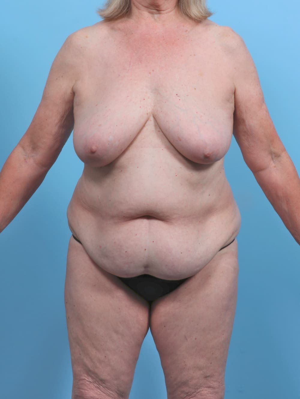 Mommy Makeover case #4972 before, image 1