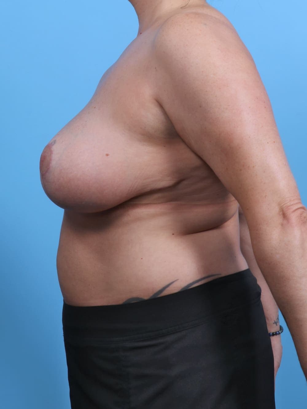 Breast Lift/Reduction case #3562 after, image 3