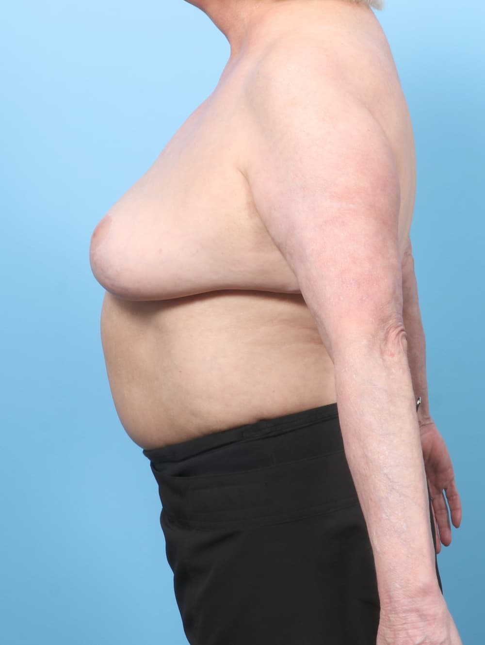 Breast Implant Removal with Lift case #7952 after, image 3