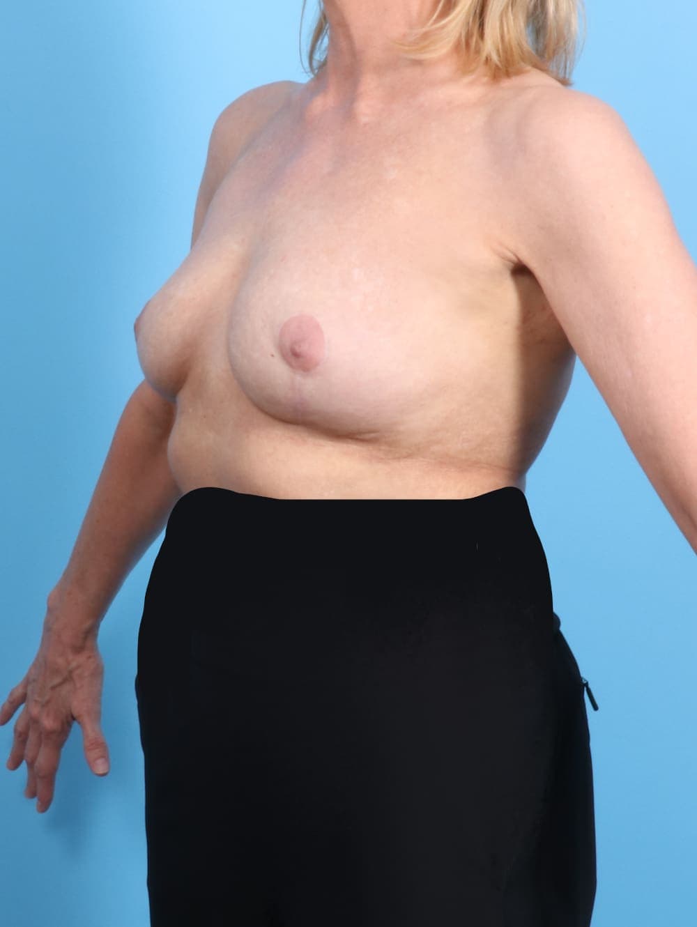 Breast Implant Removal with Lift case #1949 after, image 2