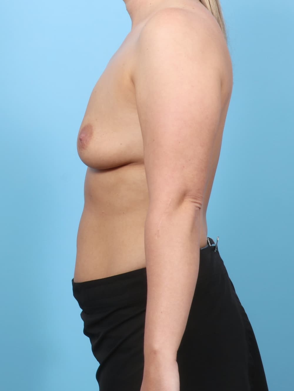 Breast Lift with Implants case #7305 before, image 3