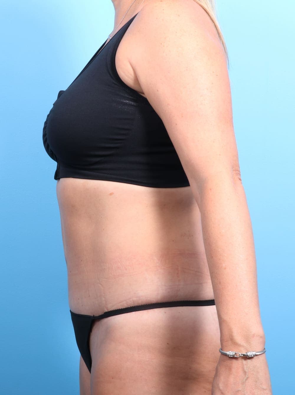 Tummy Tuck case #1240 after, image 3