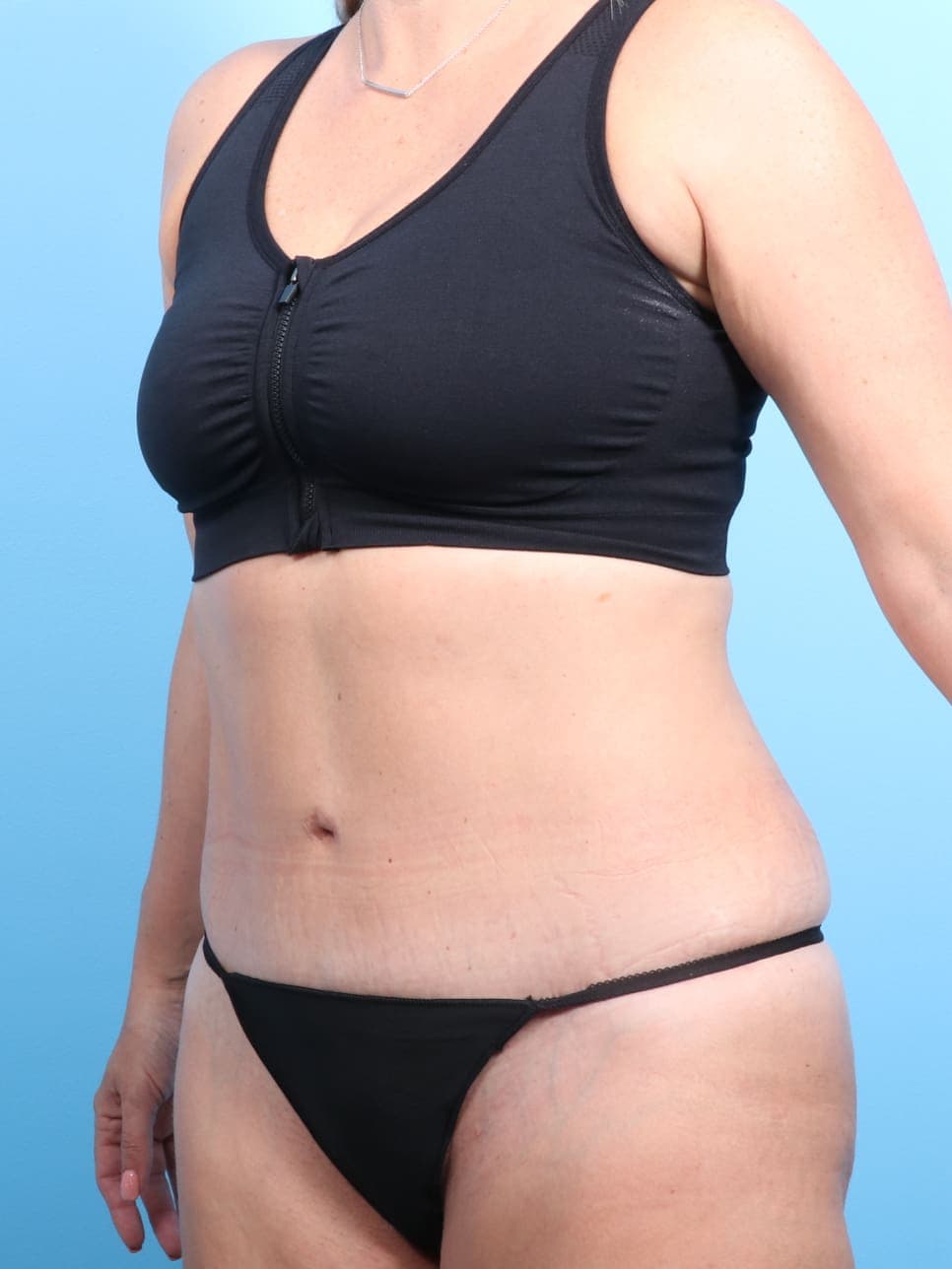 Tummy Tuck case #1240 after, image 2