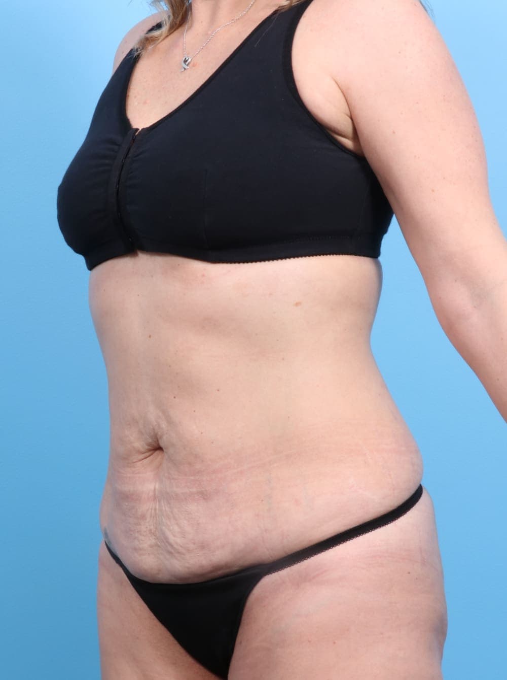 Tummy Tuck case #1240 before, image 2