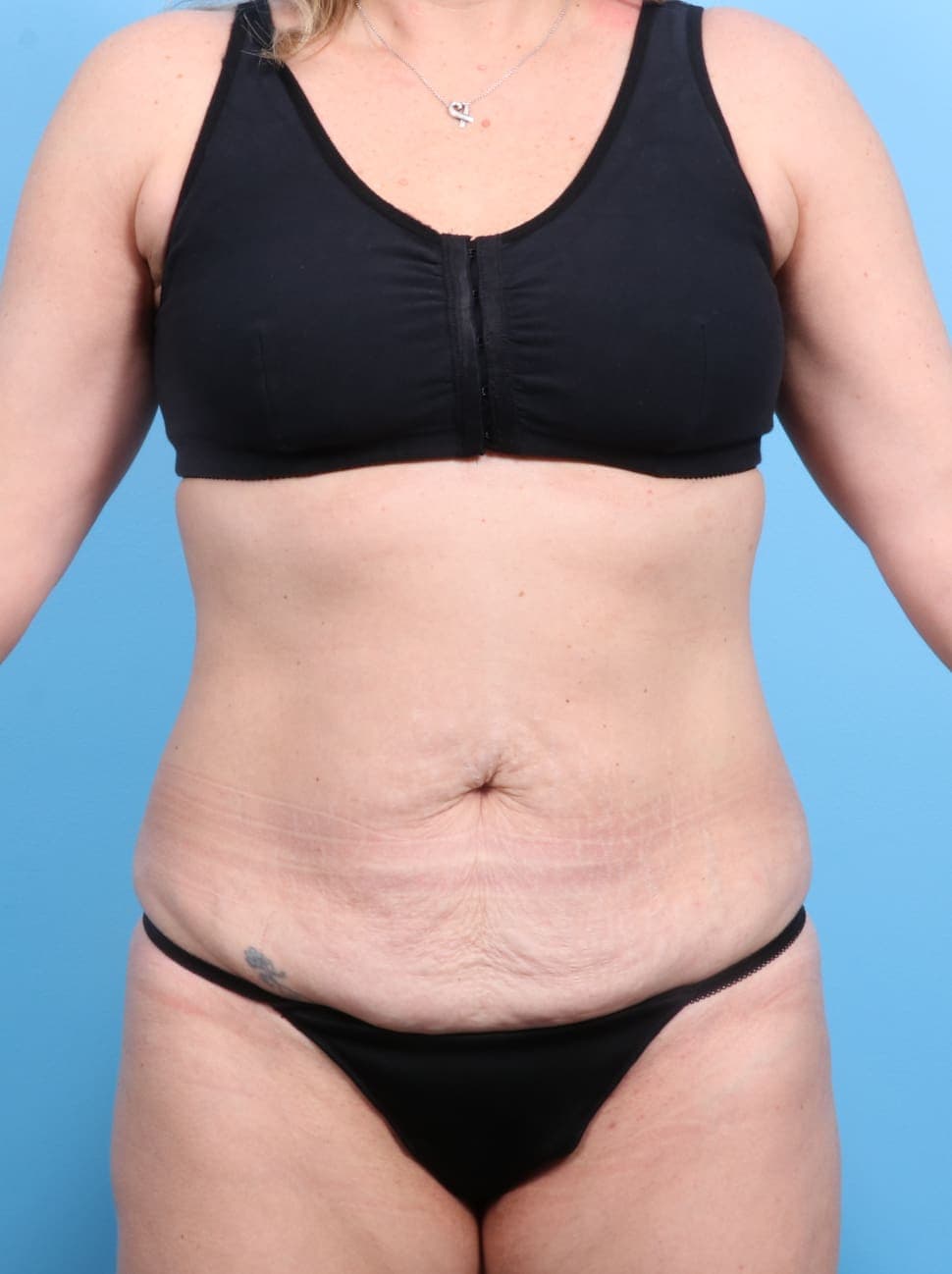 Tummy Tuck case #1240 before, image 1