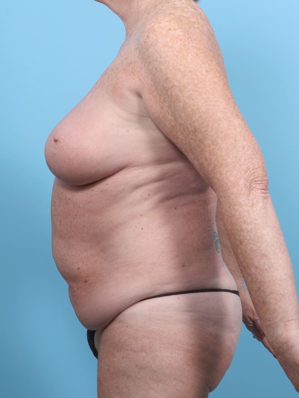 Tummy Tuck case #6489 before, image 3