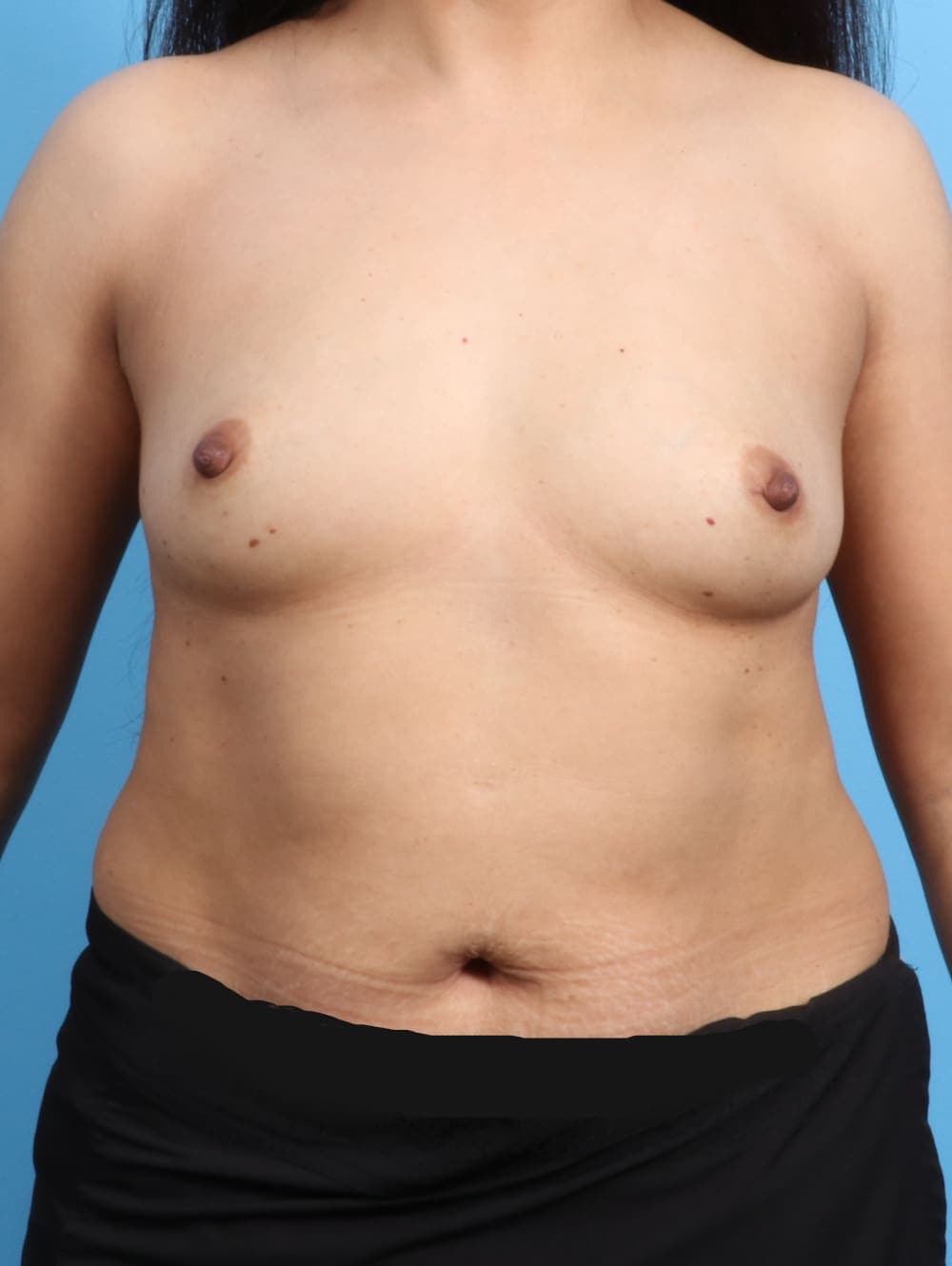 Breast Augmentation case #2436 before, image 1