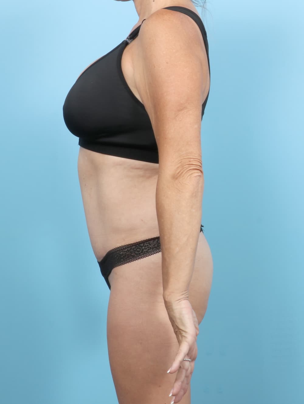 Tummy Tuck case #7088 after, image 3