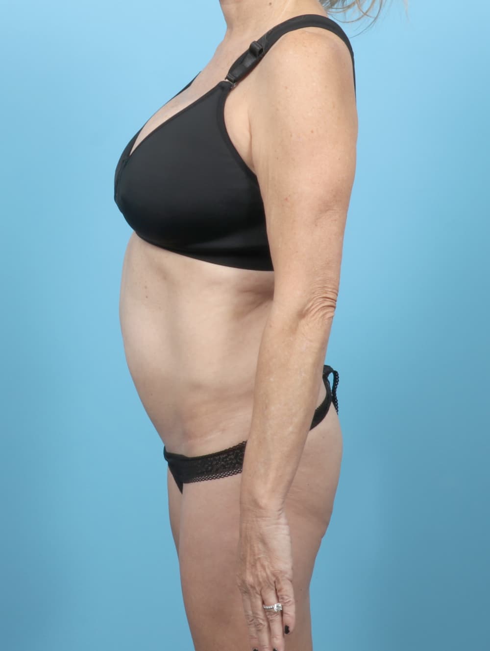 Tummy Tuck case #7088 before, image 3