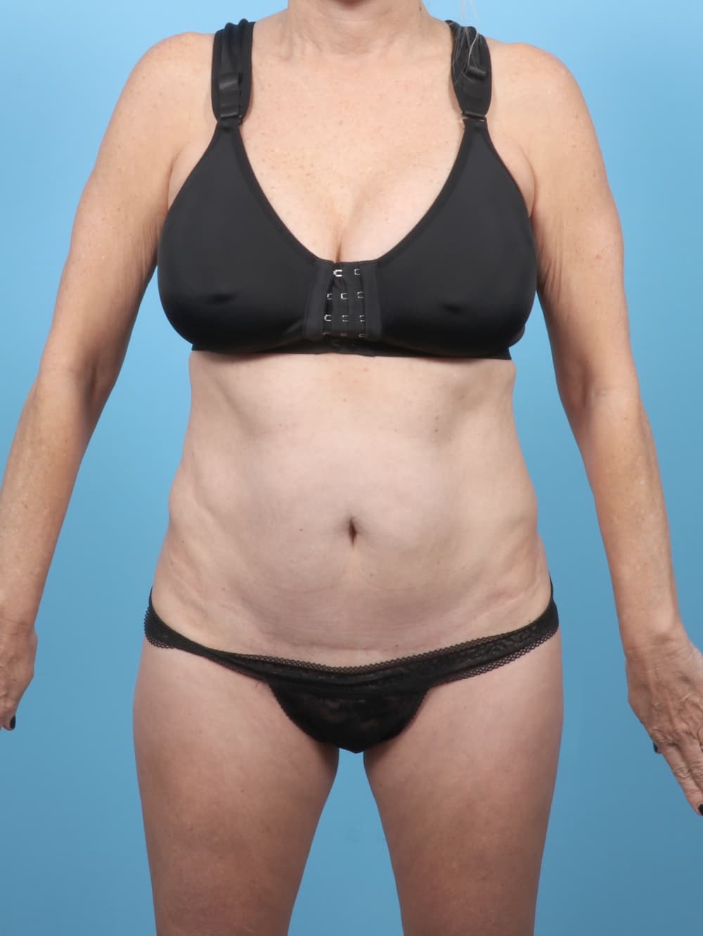 Tummy Tuck case #7088 before, image 1