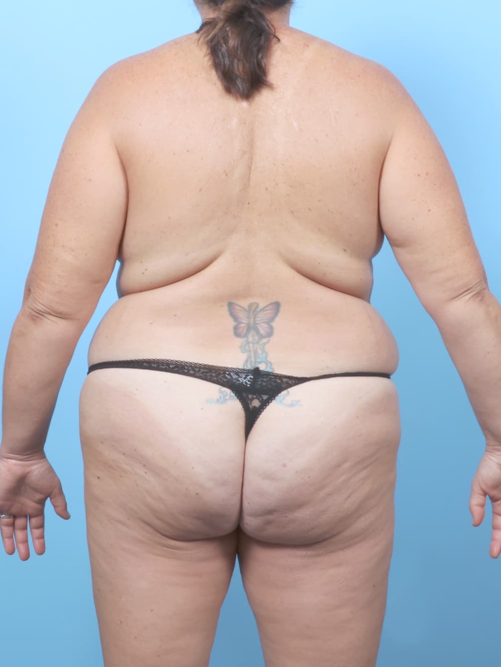 Mommy Makeover case #8860 before, image 4