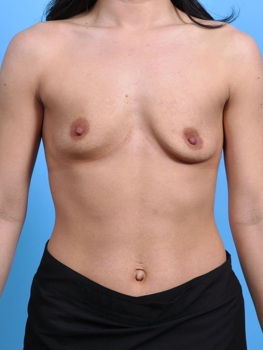 Breast Augmentation case #3811 before, image 1