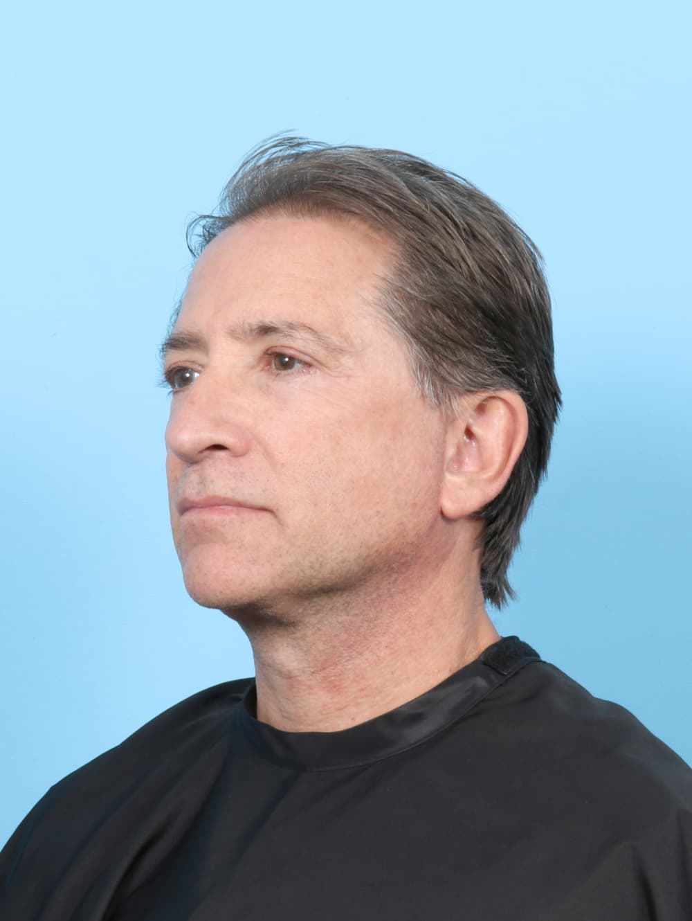 Facelift case #7419 after, image 3