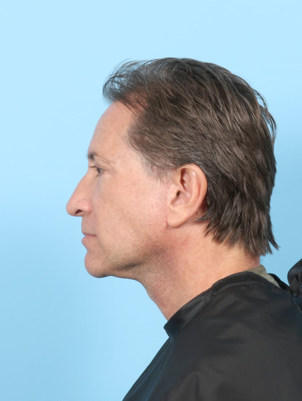 Facelift case #7419 after, image 4