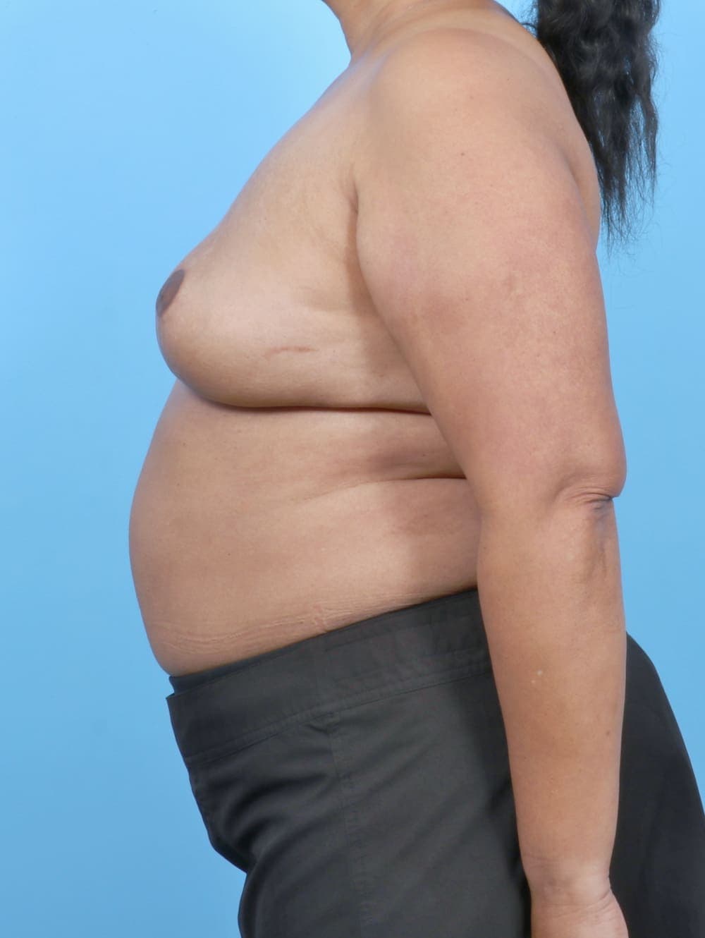 Breast Implant Revision case #6221 after, image 3