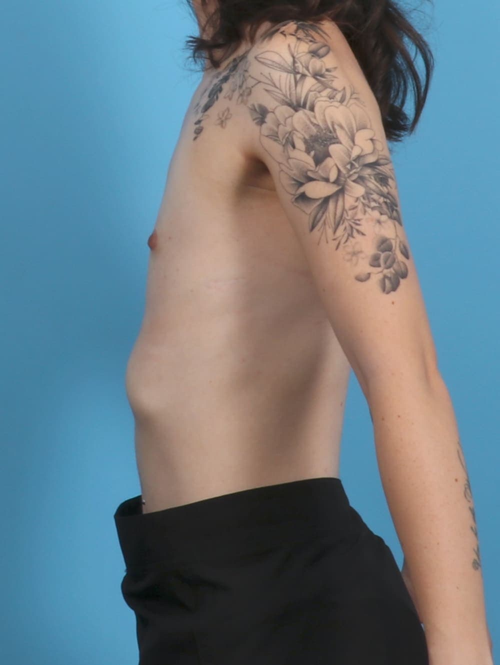 Breast Augmentation case #4818 before, image 3