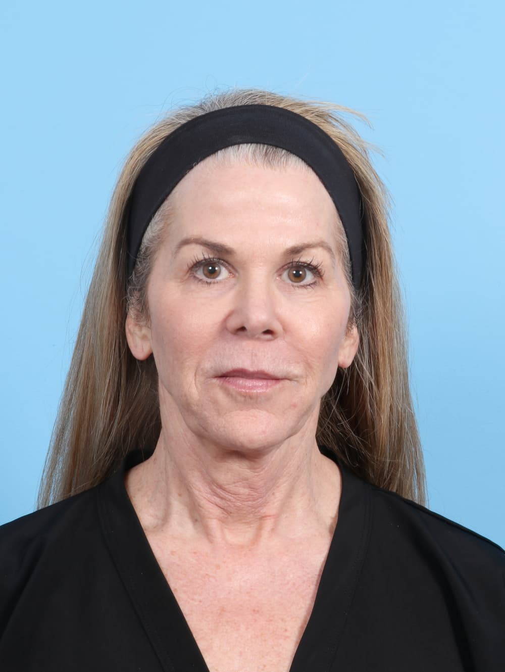 Facelift case #7382 before, image 1