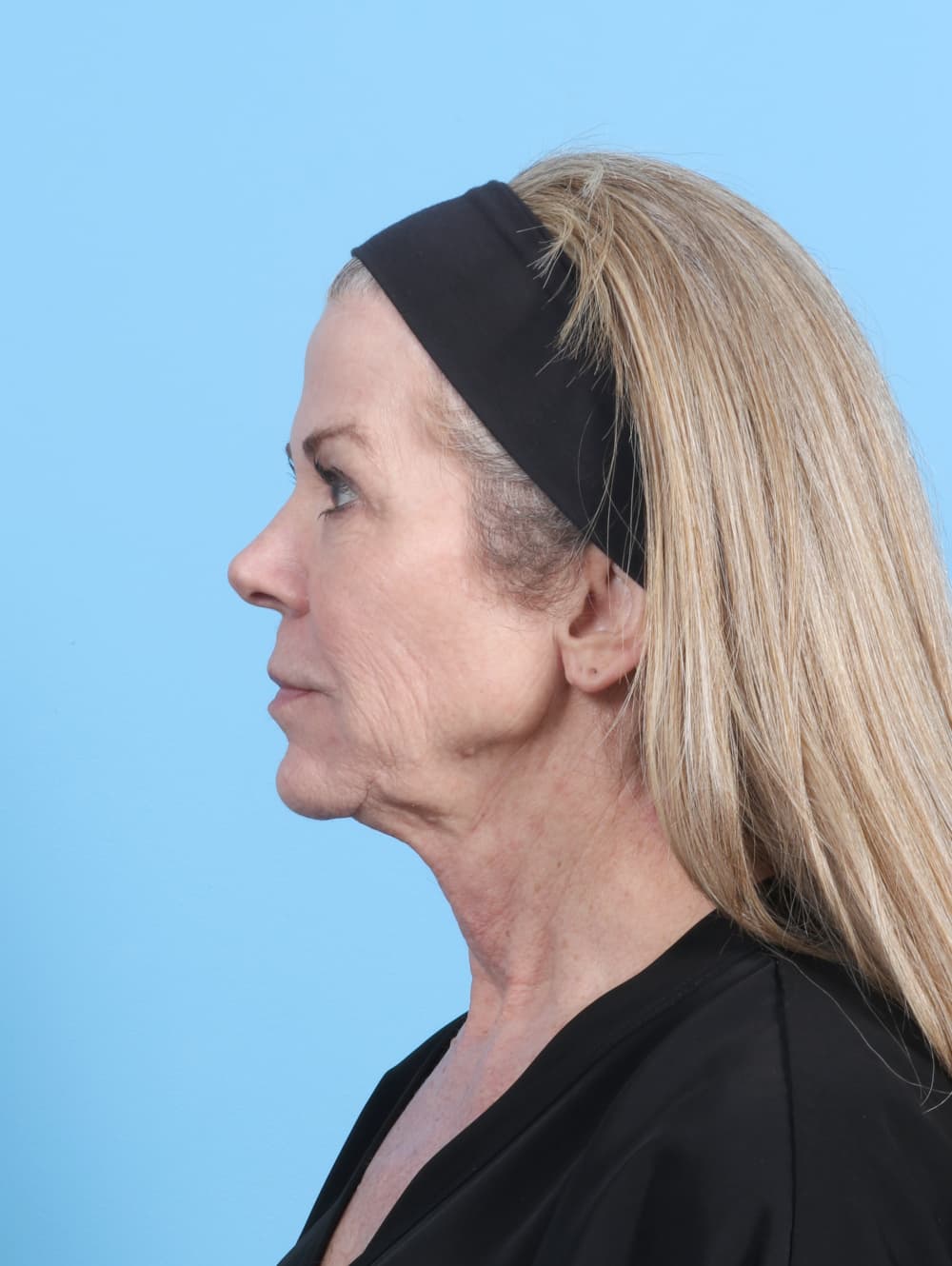 Facelift case #7382 before, image 3