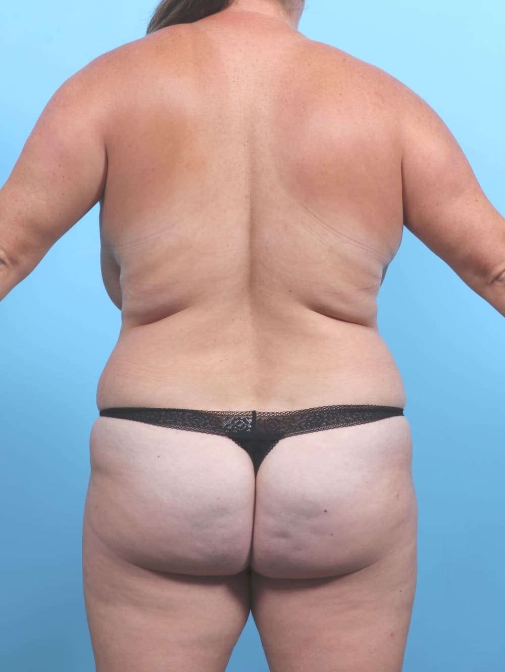 Breast Lift with Implants case #6479 before, image 2