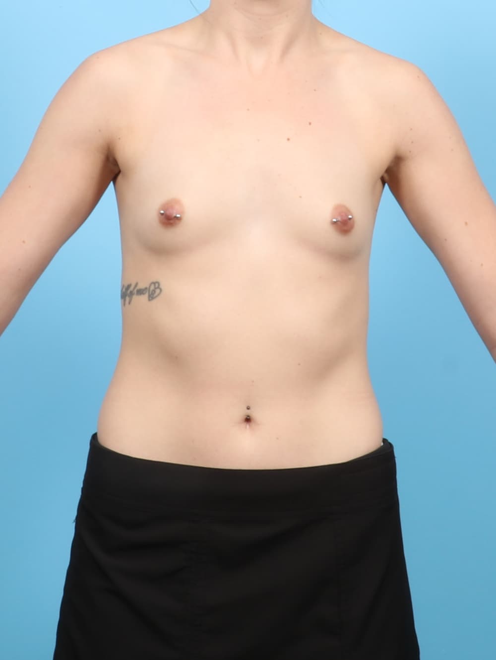 Breast Augmentation case #7734 before, image 1