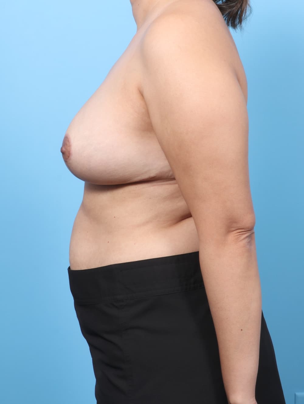 Breast Implant Revision case #8962 after, image 3