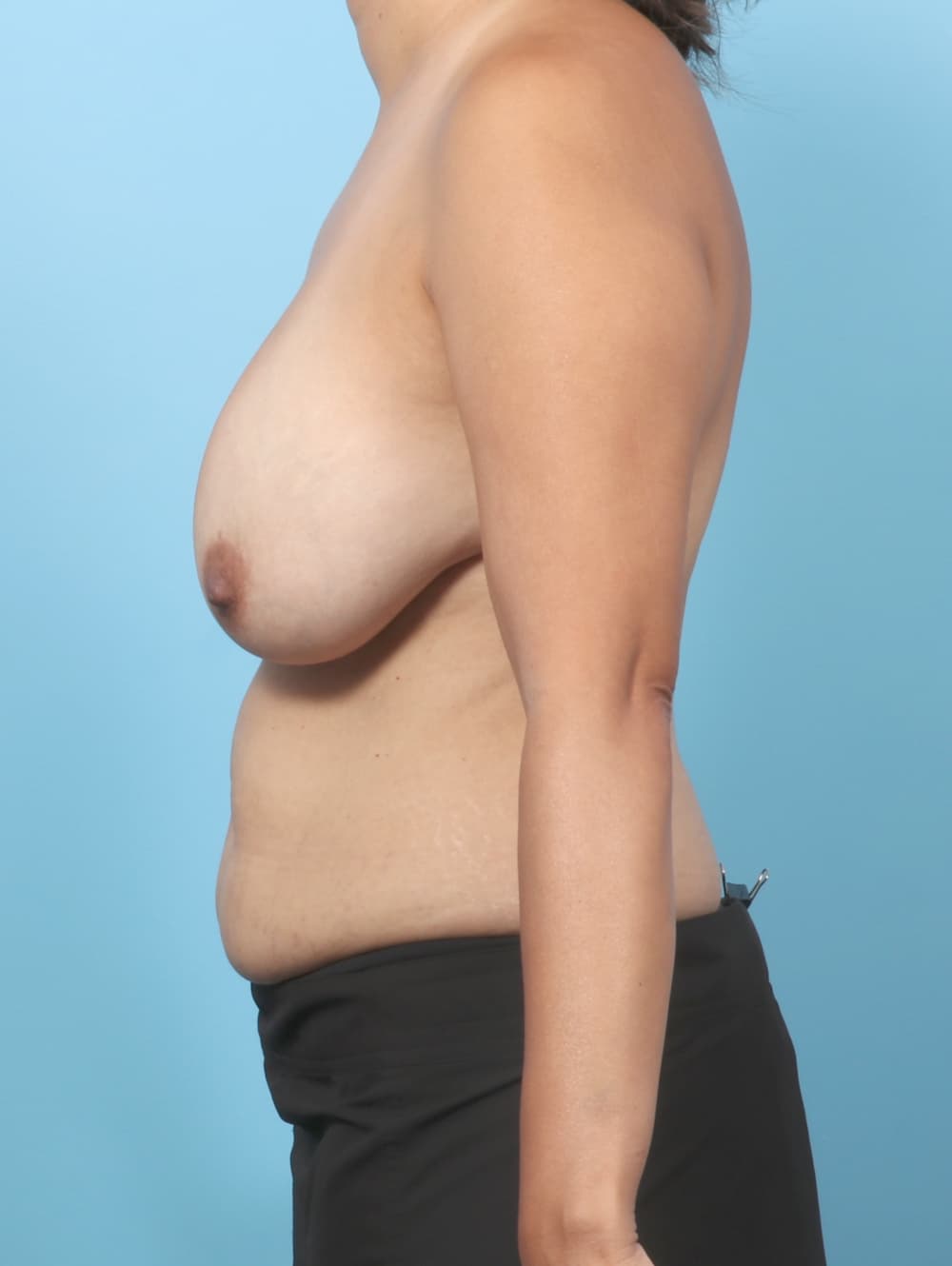 Breast Implant Revision case #8962 before, image 3