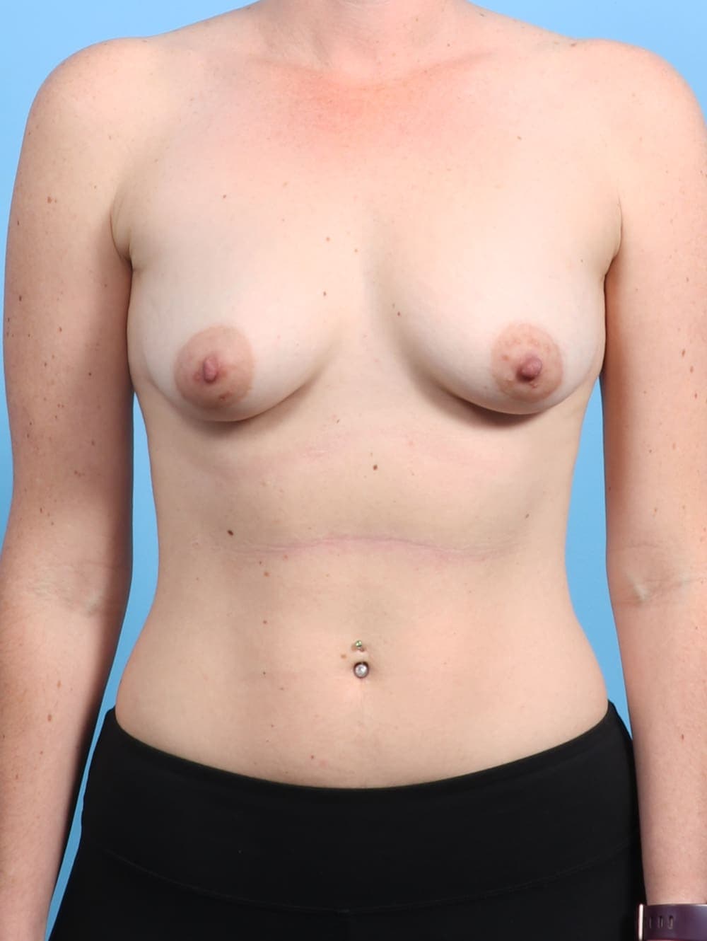 Breast Augmentation case #2865 before, image 1