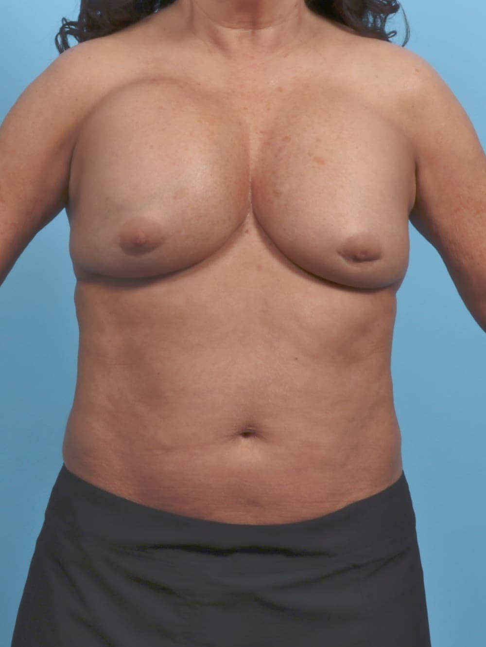 Breast Implant Revision case #5359 before, image 1