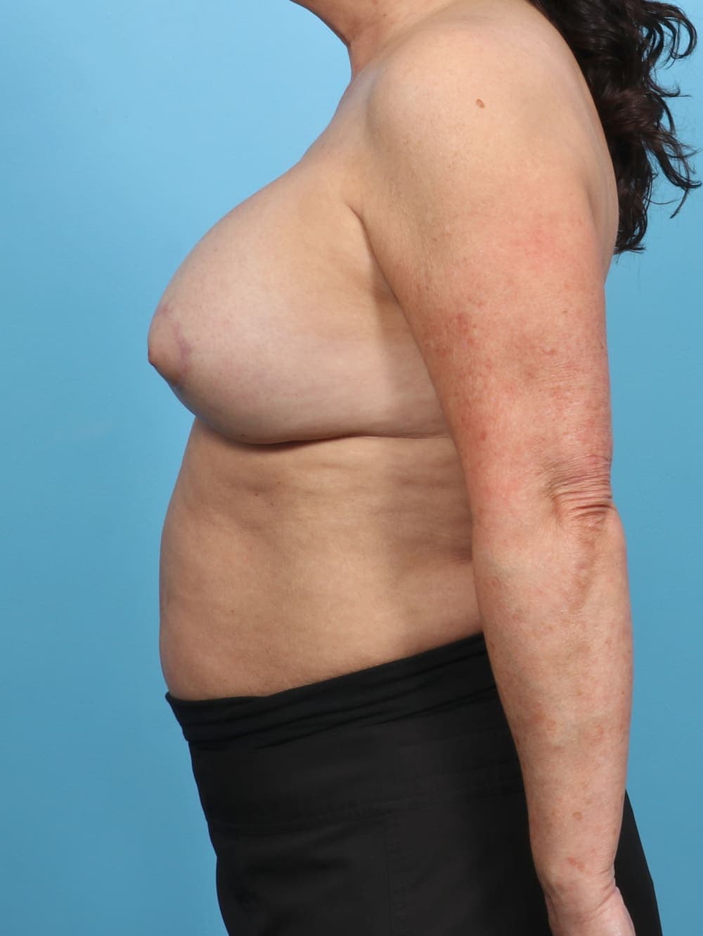 Breast Implant Revision case #5359 after, image 3