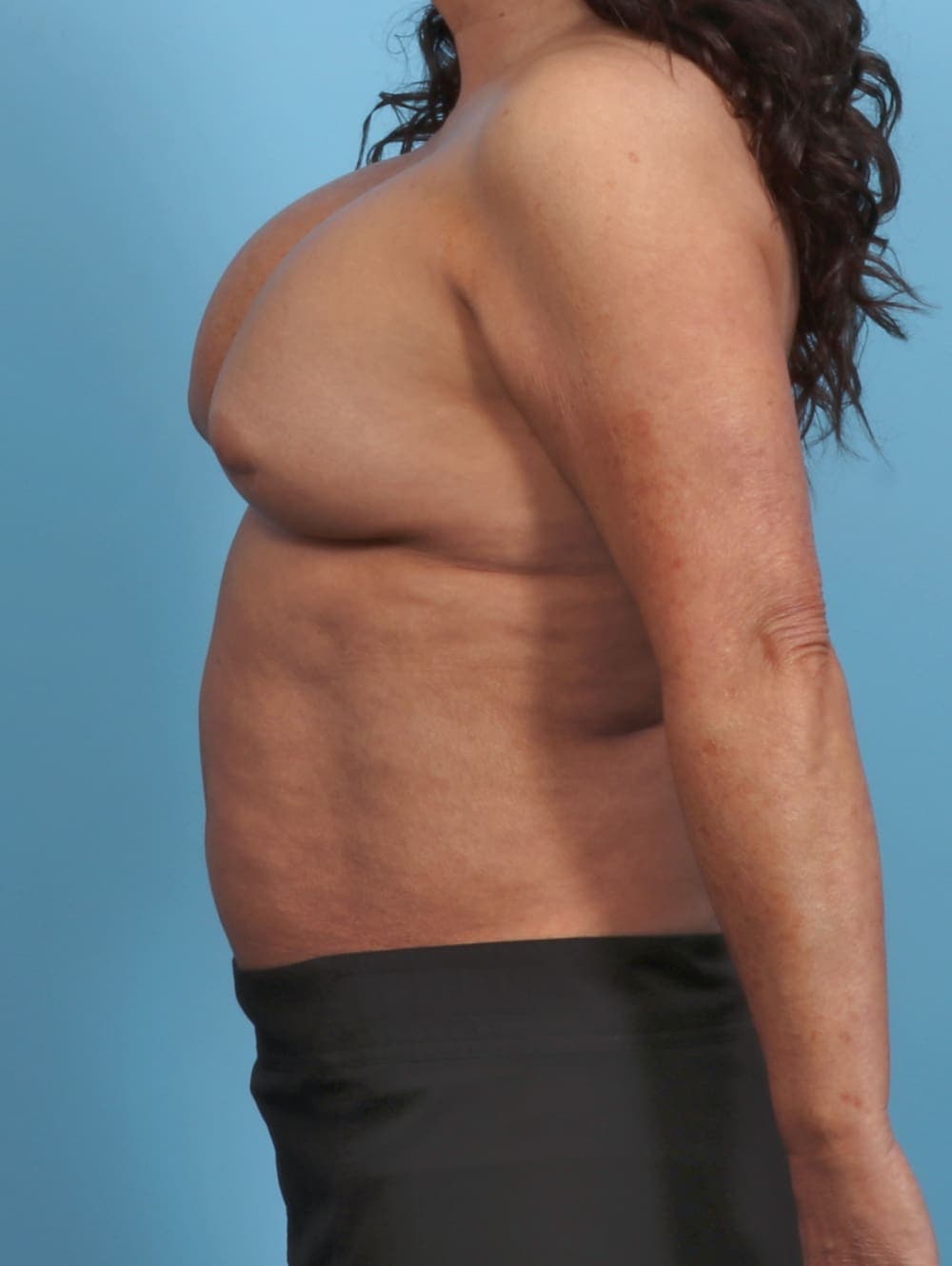 Breast Implant Revision case #5359 before, image 3