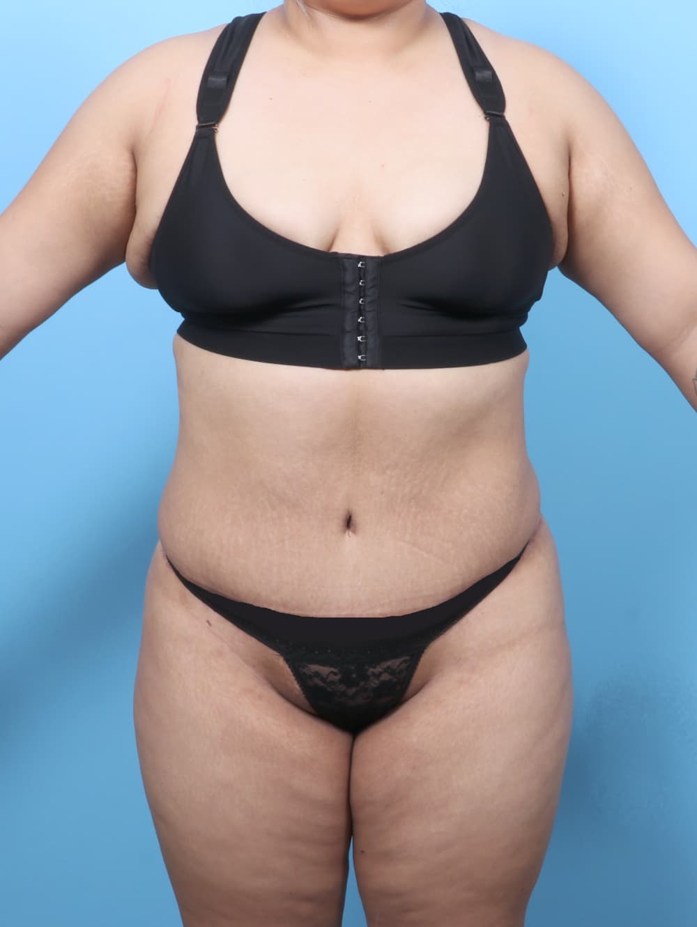 Tummy Tuck case #8738 after