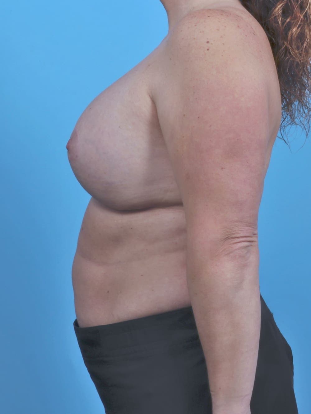 Breast Lift/Reduction case #4395 after, image 3