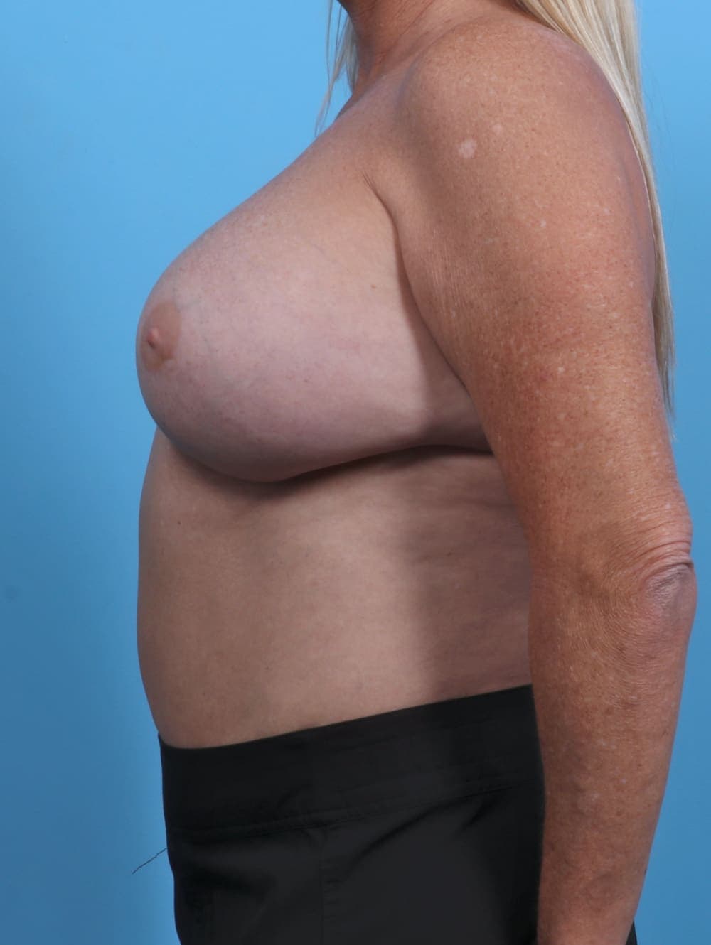 Breast Implant Revision case #3771 after, image 3