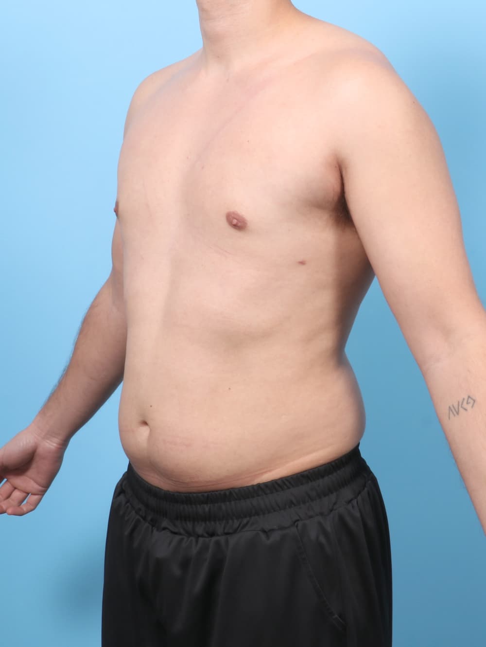 Male Breast Reduction case #7990 after, image 2