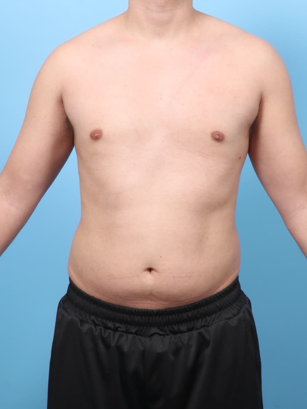 Male Breast Reduction case #7990 after, image 1