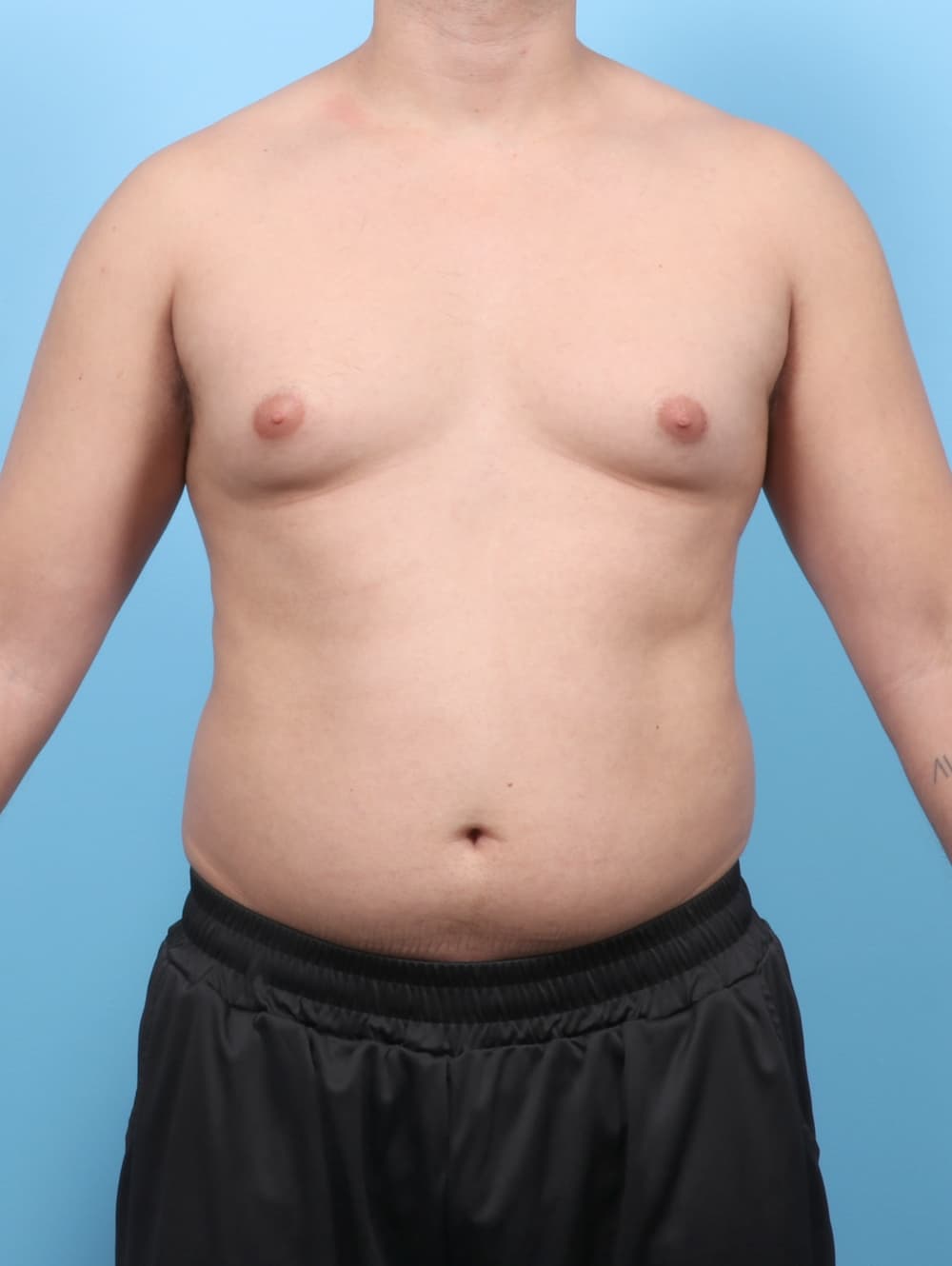 Male Breast Reduction case #7990 before, image 1