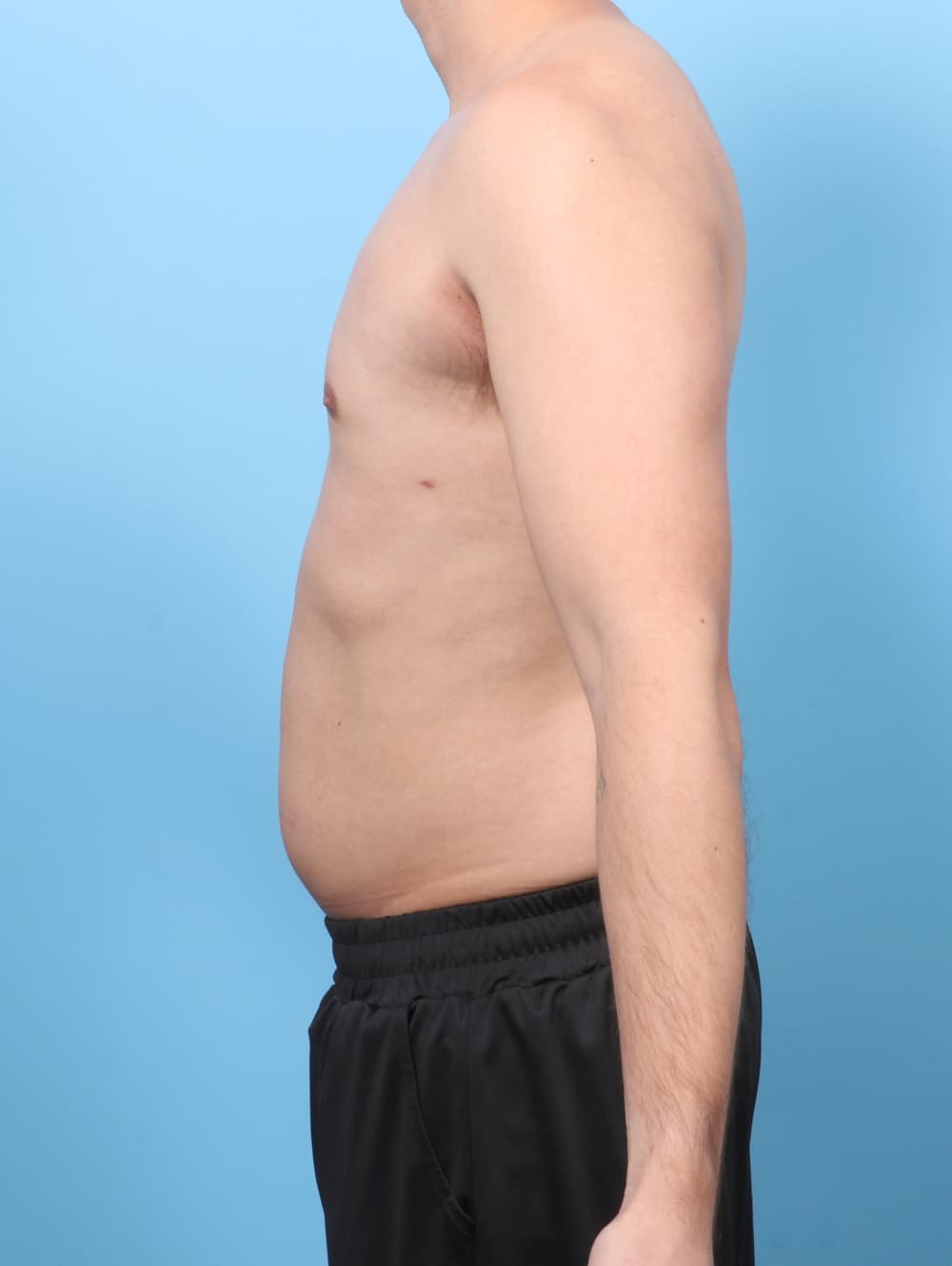 Male Breast Reduction case #7990 after, image 3