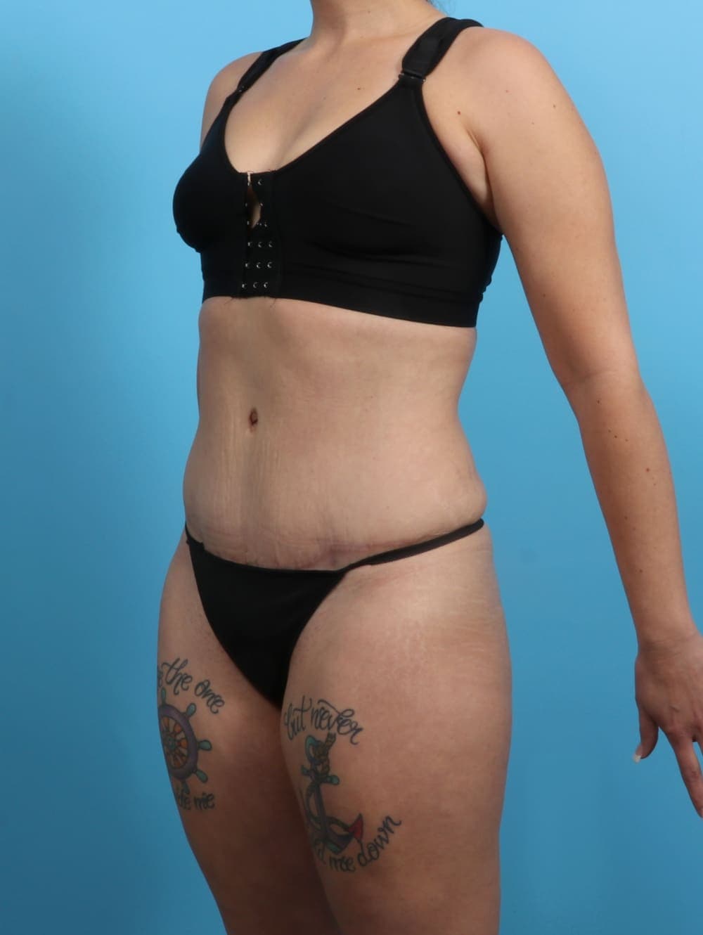 Tummy Tuck case #3193 after, image 3