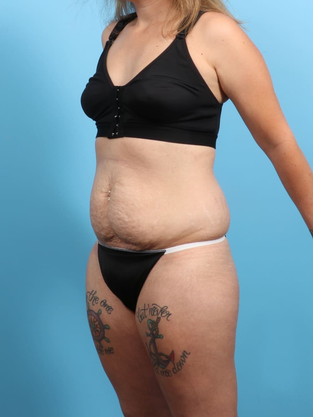 Tummy Tuck case #3193 before, image 3